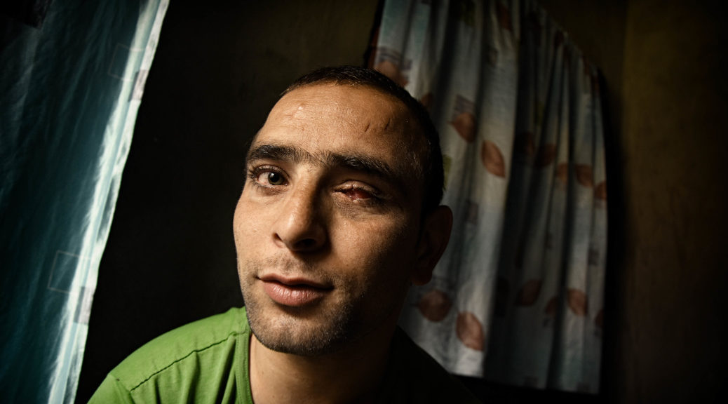 Photo of man partially blinded in one eye by pellets
